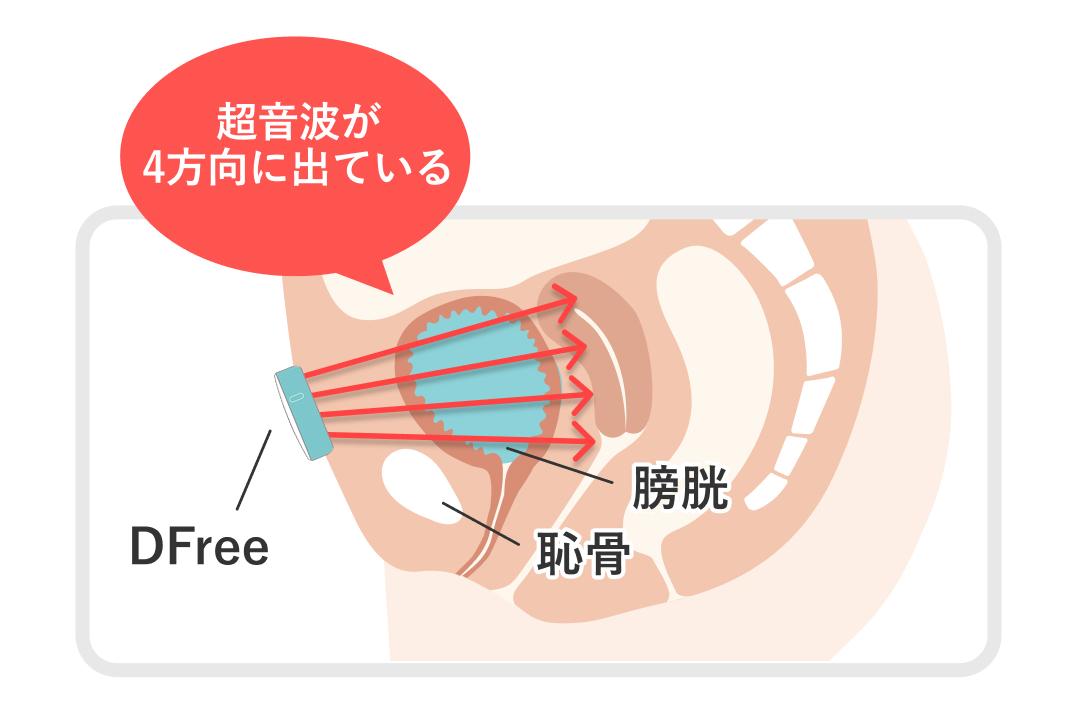 膀胱の状態をモニタリング